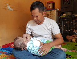 Dikaruniai Bayi Kembar Siam Rahman dan Rahim dengan Kondisi Jantung Menyatu, Orangtua: Seperti Mimpi