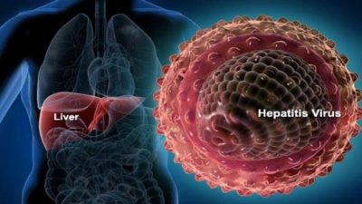 Ilustrasi hepatitis akut