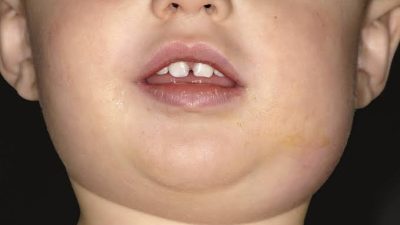 Ilustrasi penyakit gondongan