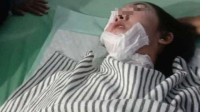 Korban Penyiraman Air Kepas di Jalan Raya Perjuangan Teluk Pucung Bekasi Utara