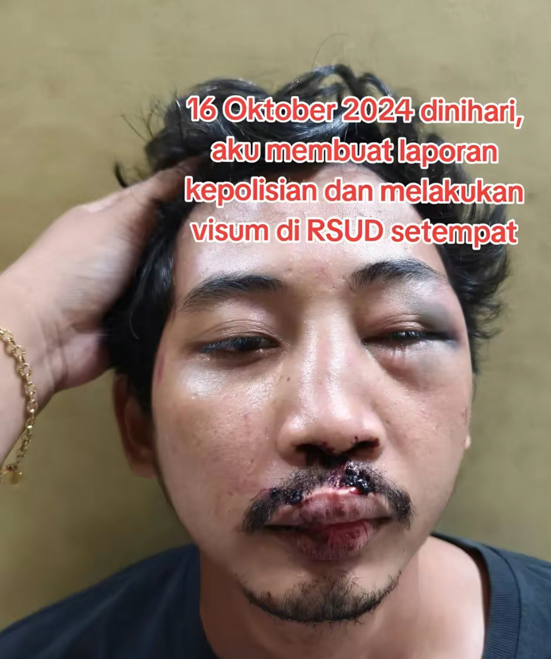 Kondisi korban usai dikeroyok babak belur