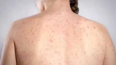 Kasus Campak di Kabupaten Bekasi Turun, 2025 Nihil Positif