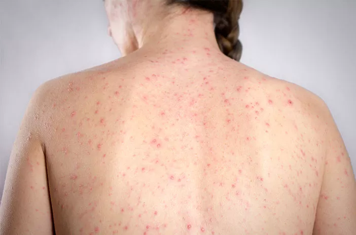 Bekasi - Ilustrasi penyakit campak