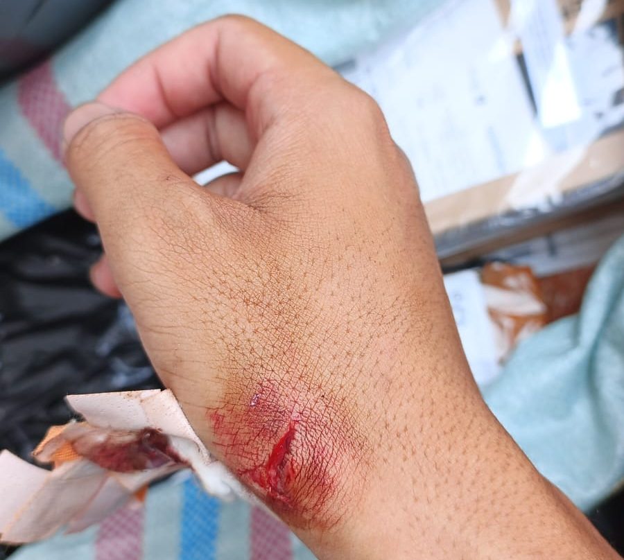 Kota Bekasi - Kondisi tangan kurir jasa ekspedisi JNT bernama Irsyad D (22) usai dsabet mandau oleh pelanggannya usai antar paket COD di Perumahan Harapan Jaya, Jalan Gunung Lauser, Bekasi Utara, Kota Bekasi, Jumat, (26/9/2025) siang. Foto: Ist/Gobekasi.id.
