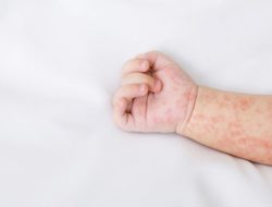 1.414 Kasus Suspek Campak Ditemukan, Balita di Kota Bekasi Terancam Jelang Lebaran