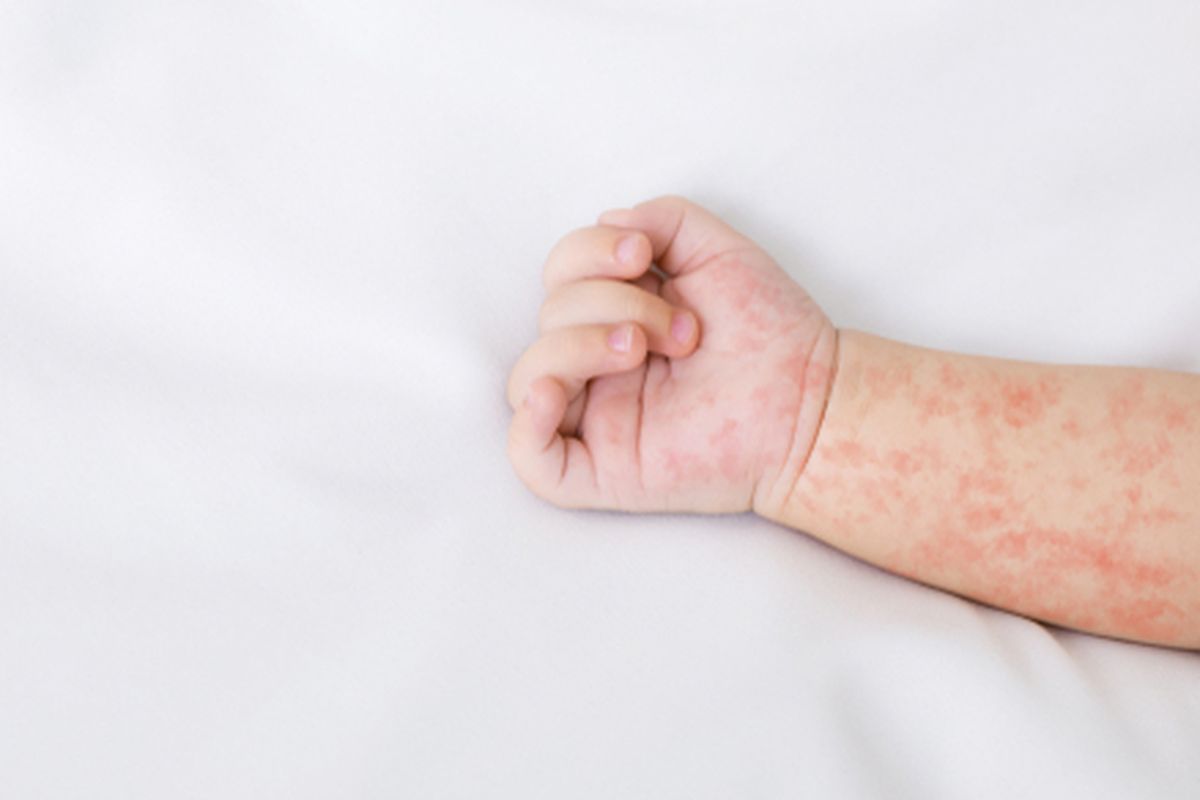 Bekasi - Ilustrasi suspek campak pada Balita