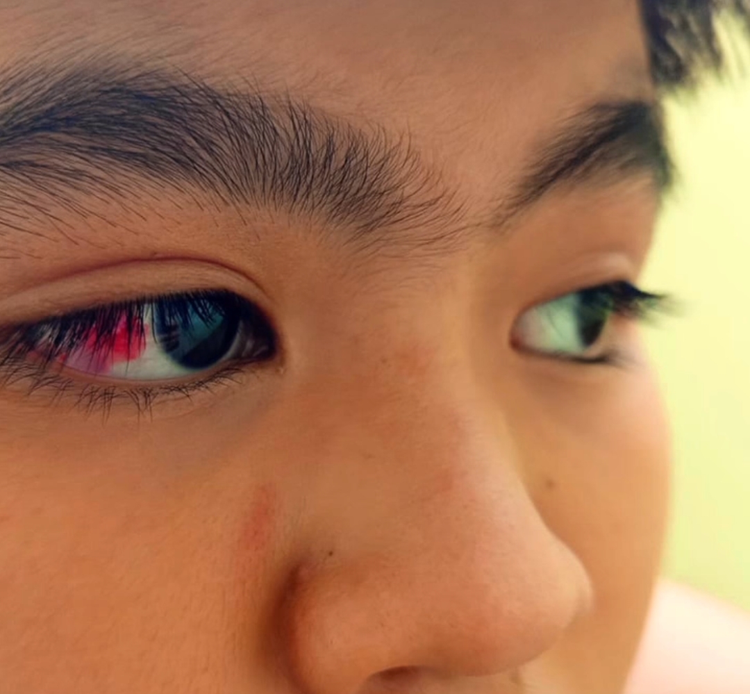 Bekasi - Kondisi bola mata Keanu Alif Arzachel Zaen (13), siswa kelas VII/C di Alexandria Boarding Islamic School yang berlokasi di kawasan Rawalumbu, Kota Bekasi. Foto: Ist/Tangkapan layar video